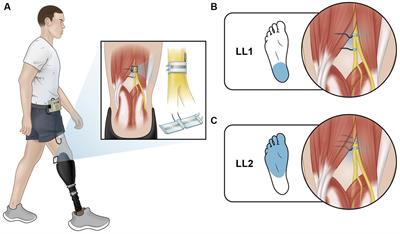 Neural sensory stimulation does not interfere with the H-reflex in individuals with lower limb amputation